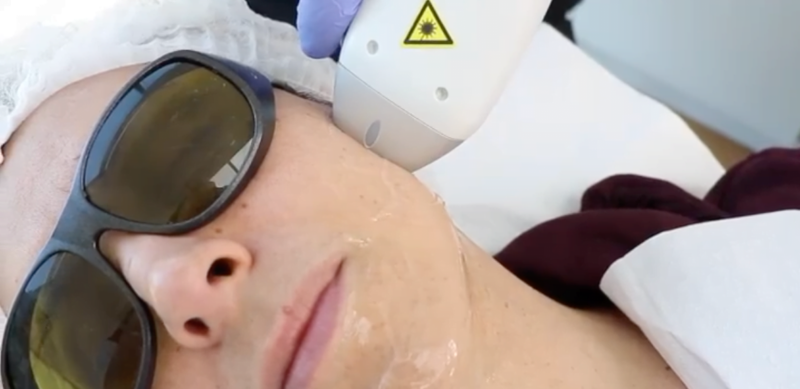 Depilación Láser Permanente Soprano ICE Facial | Láser Soprano
