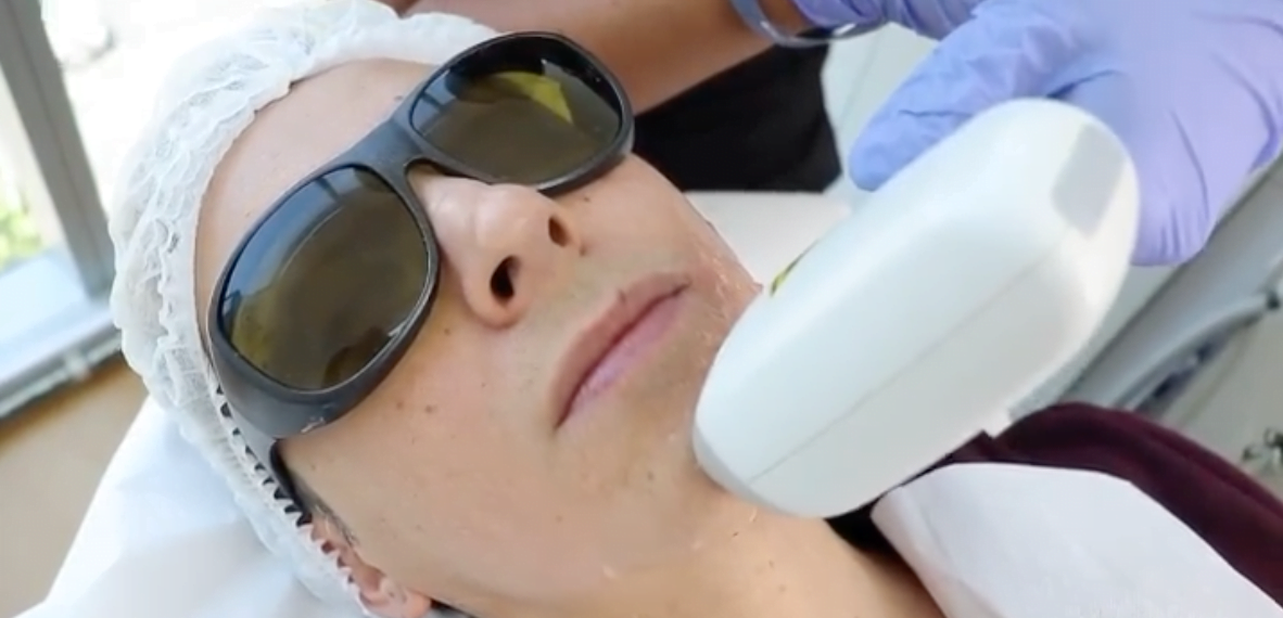 Depilación Láser Permanente Soprano ICE Facial | Láser Soprano