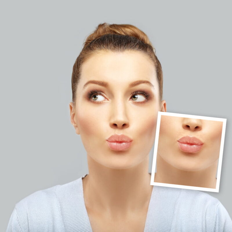 Depilación Láser Permanente Soprano ICE Facial | Láser Soprano ice
